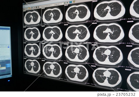 胸部 Ct 検査 肺の写真素材