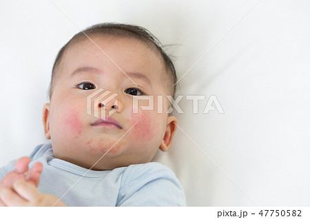 新生児ニキビの写真素材