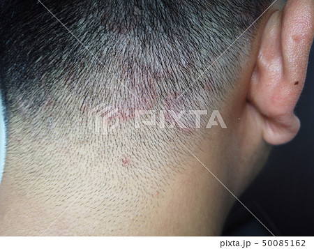 頭皮湿疹の写真素材