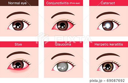 角膜ヘルペスの写真素材