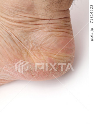 肌割れの写真素材